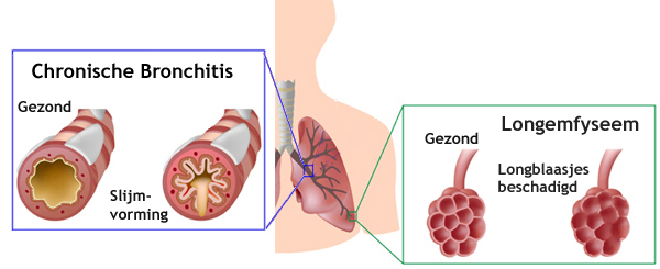 Chronische bronchitis en longemfyseem