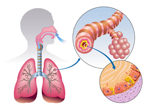 Een uitleg van chronische bronchitis
