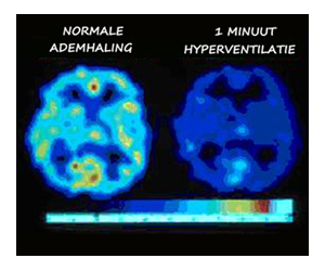 Zuurstof opname door de hersenen na 1 minuut sterke hyperventilatie